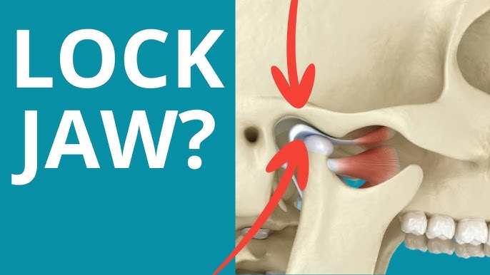 Jaw Lock Treatment